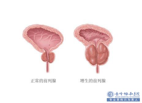 前列腺增生的诱因是什么