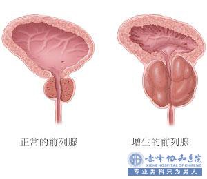 有前列腺增生能进行性生活吗