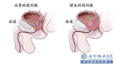 前列腺增生的原因