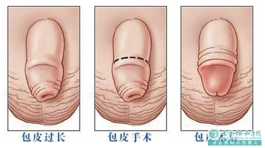 金华义乌市男性/做包皮手术好的医院在哪里